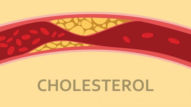 4 Makan yang Harus Dihindari Penderita Kolesterol